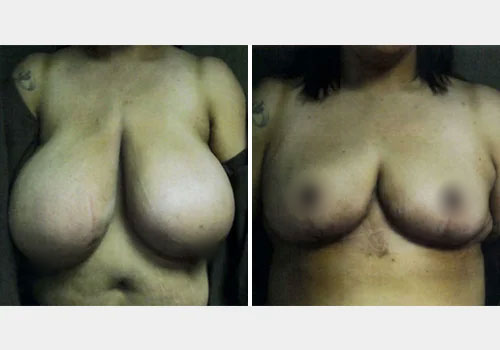 Breast Reduction Patient A