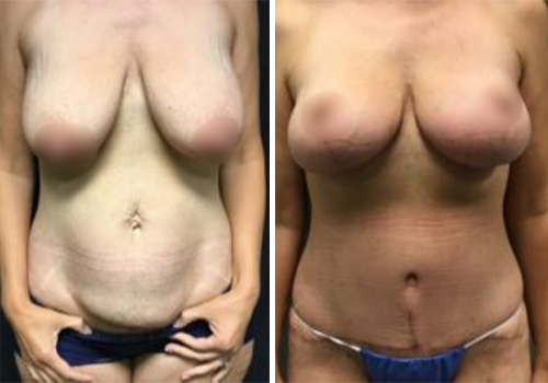 Abdominoplasty Mastopexy 10