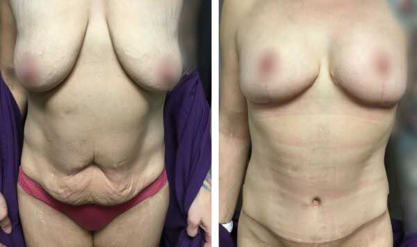 Abdominoplasty Mastopexy 12