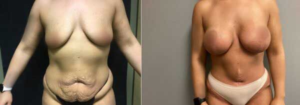 Abdominoplasty Mastopexy Augmentation 01