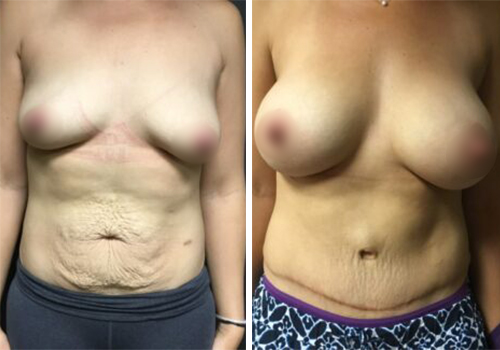 Breast Augmentation Abdominoplasty