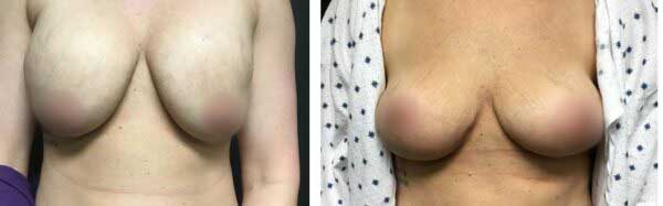 Enbloc Mastopexy 5