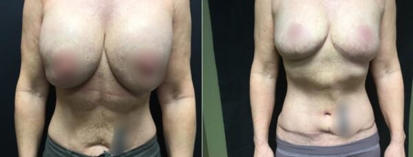 Mastopexy Abdominoplasty 08 1