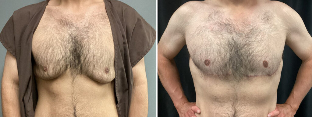 Patient 1 Gynecomastia