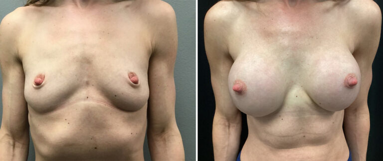 Patient 28 breast aug